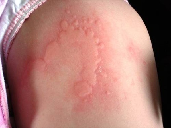 Treatment Of Common Allergic Reactions PM Press